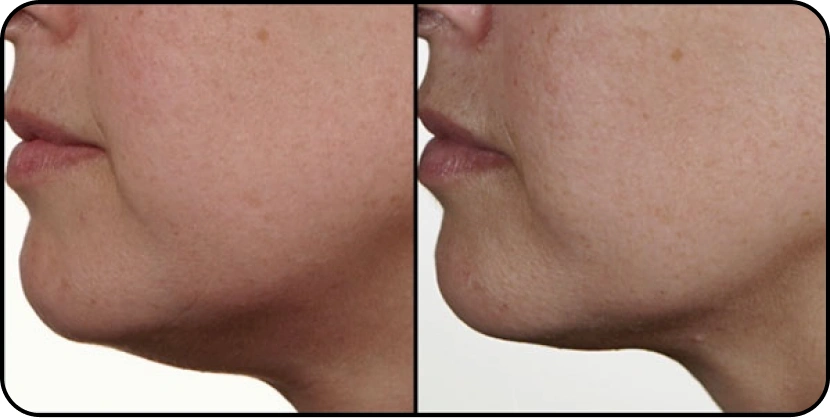 before_after_chin