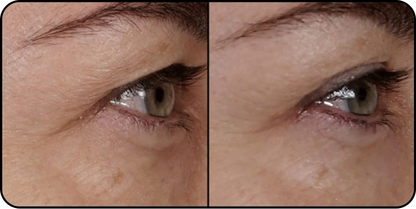 before_after_eyes